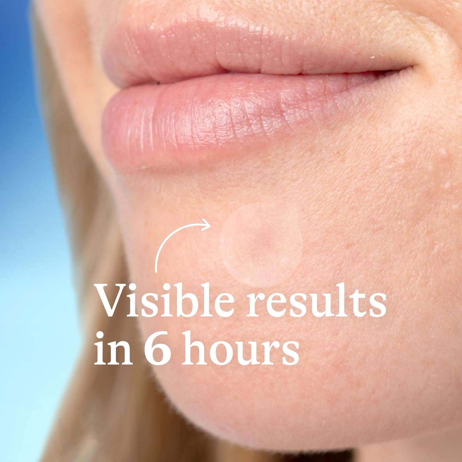 Parche Acne Granos Differin Con Acido Salicilico Y Centella - Imagen 2